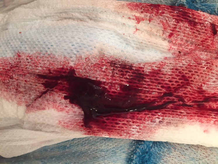 Bleeding after loosing virginity