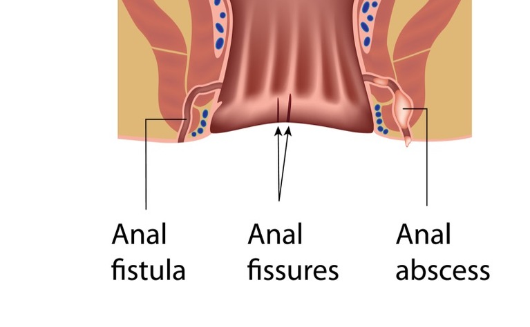 Anal fistulas and crohns disease