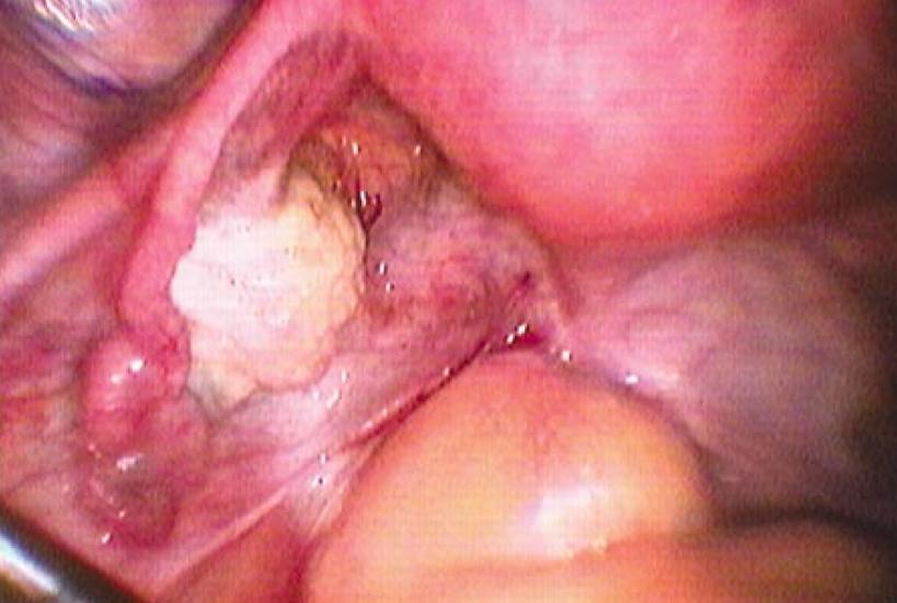 White vaginal lesion
