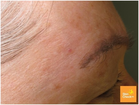 Facial cancerous moless